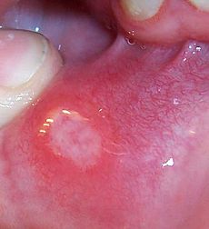 Possible canker sore on outside lip, what to do ...